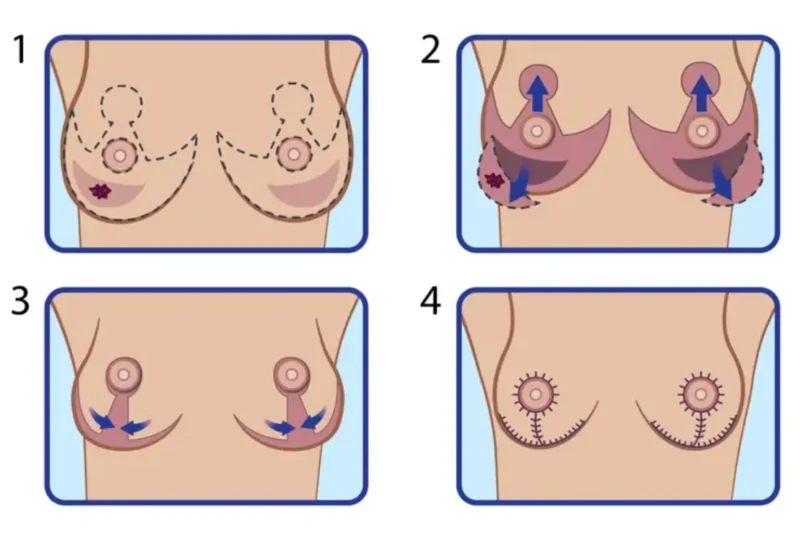 Key Factors to Consider Before Breast Reduction Surgery in Tampa