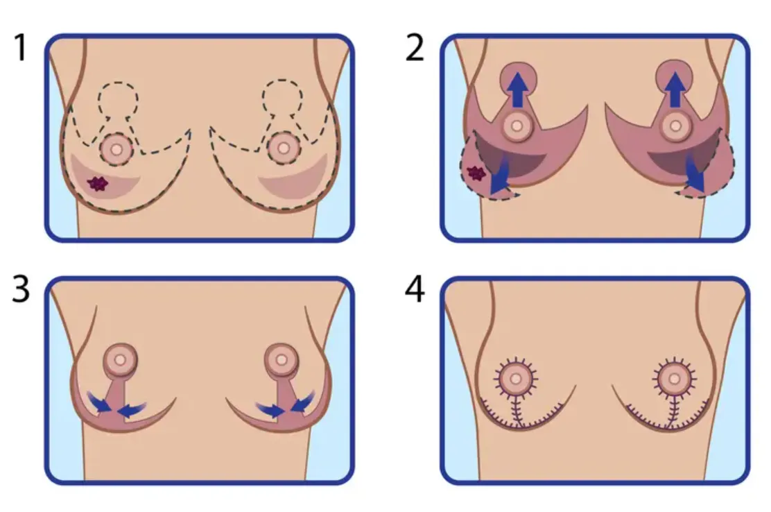 Key Factors to Consider Before Breast Reduction Surgery in Tampa